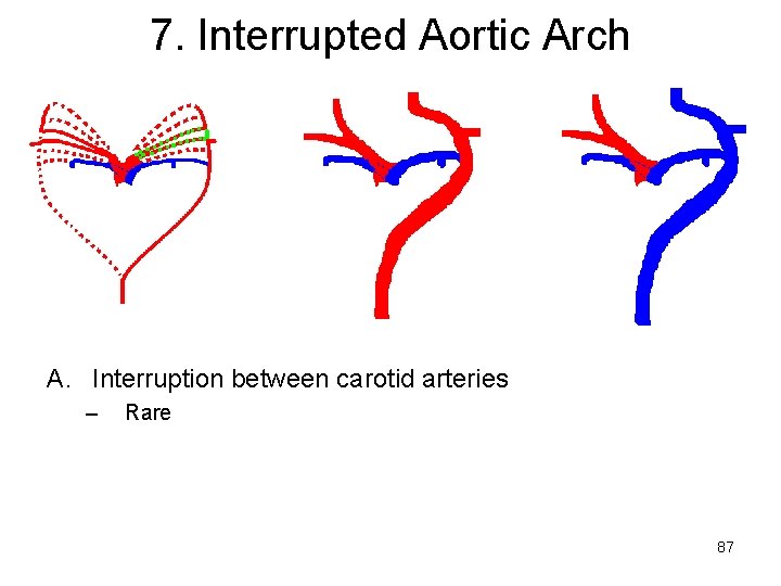 7. Interrupted Aortic Arch A. Interruption between carotid arteries – Rare 87 