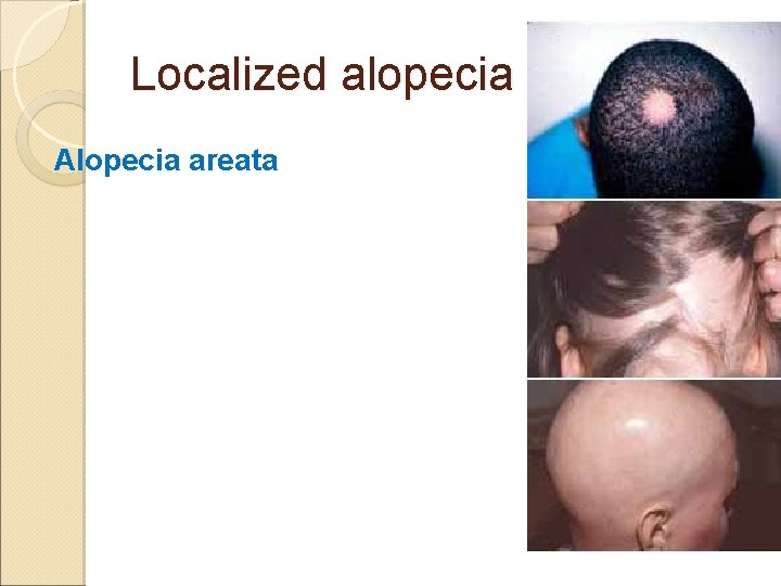 Localized alopecia Alopecia areata 