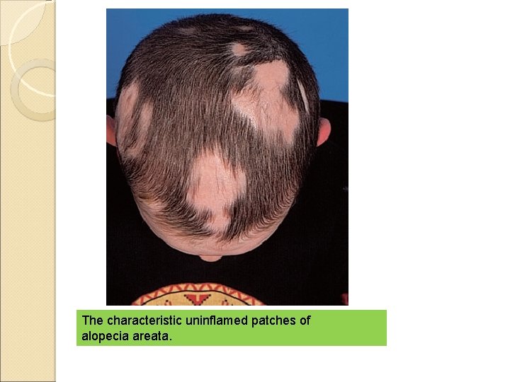 The characteristic uninflamed patches of alopecia areata. 