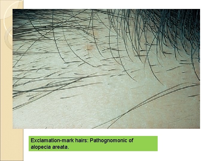 Exclamation-mark hairs: Pathognomonic of alopecia areata. 