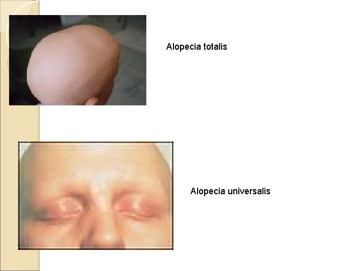 Alopecia totalis Alopecia universalis 