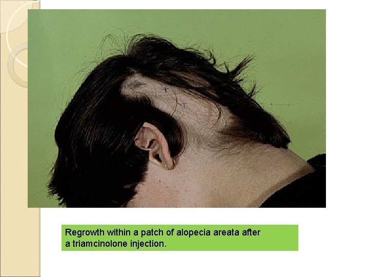 Regrowth within a patch of alopecia areata after a triamcinolone injection. 