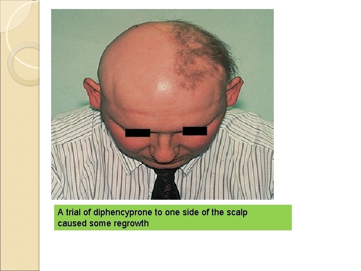 A trial of diphencyprone to one side of the scalp caused some regrowth 