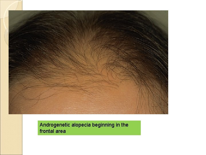 Androgenetic alopecia beginning in the frontal area 