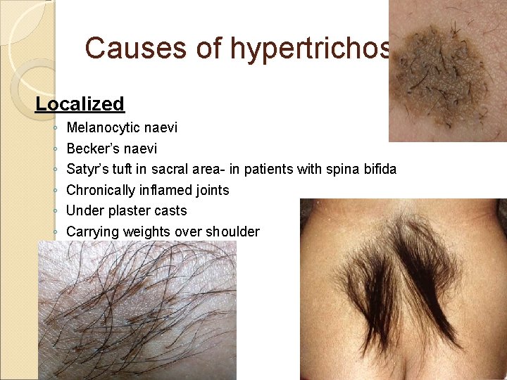 Causes of hypertrichosis Localized ◦ ◦ ◦ Melanocytic naevi Becker’s naevi Satyr’s tuft in