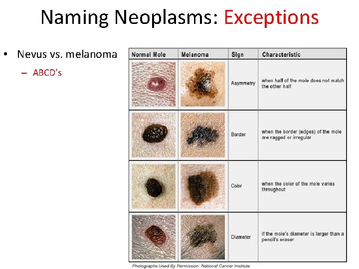 Naming Neoplasms: Exceptions • Nevus vs. melanoma – ABCD’s 