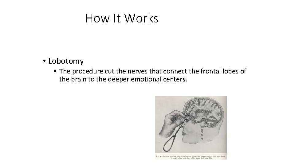 How It Works • Lobotomy • The procedure cut the nerves that connect the