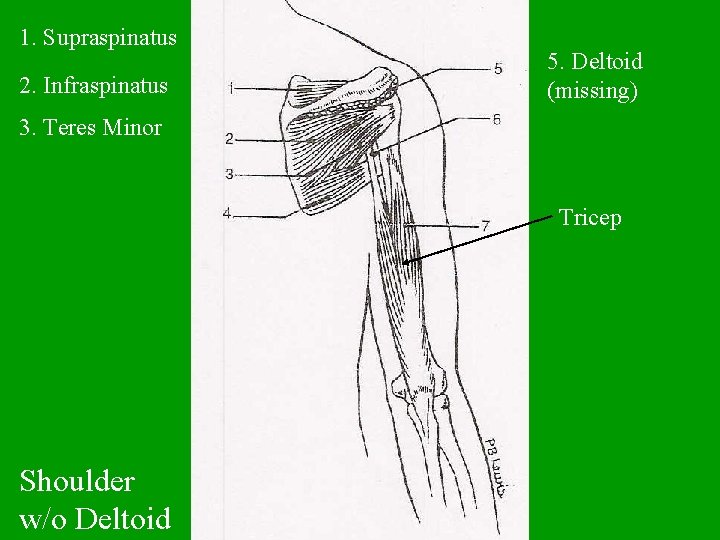 1. Supraspinatus 2. Infraspinatus 5. Deltoid (missing) 3. Teres Minor Tricep Shoulder w/o Deltoid