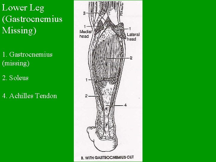 Lower Leg (Gastrocnemius Missing) 1. Gastrocnemius (missing) 2. Soleus 4. Achilles Tendon 