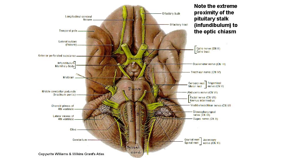 Note the extreme proximity of the pituitary stalk (infundibulum) to the optic chiasm 