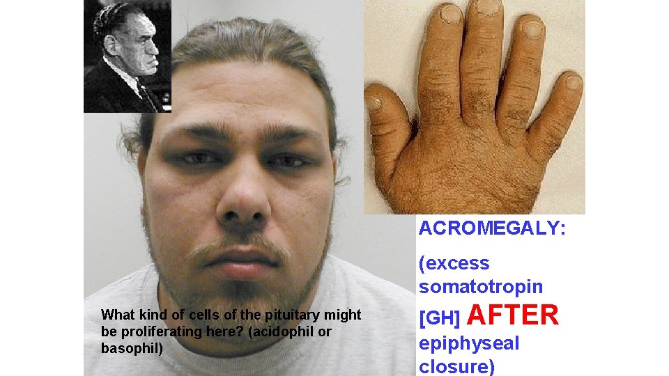 ACROMEGALY: (excess somatotropin What kind of cells of the pituitary might be proliferating here?