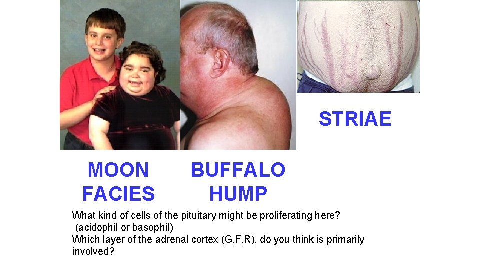 STRIAE MOON FACIES BUFFALO HUMP What kind of cells of the pituitary might be