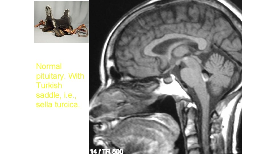 Normal pituitary. With Turkish saddle, i. e. , sella turcica. 