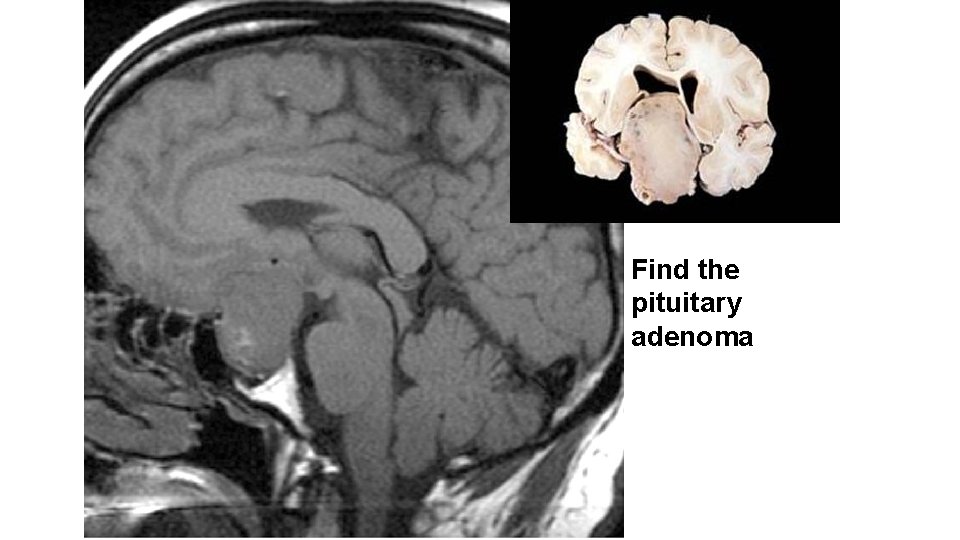 Find the pituitary adenoma 