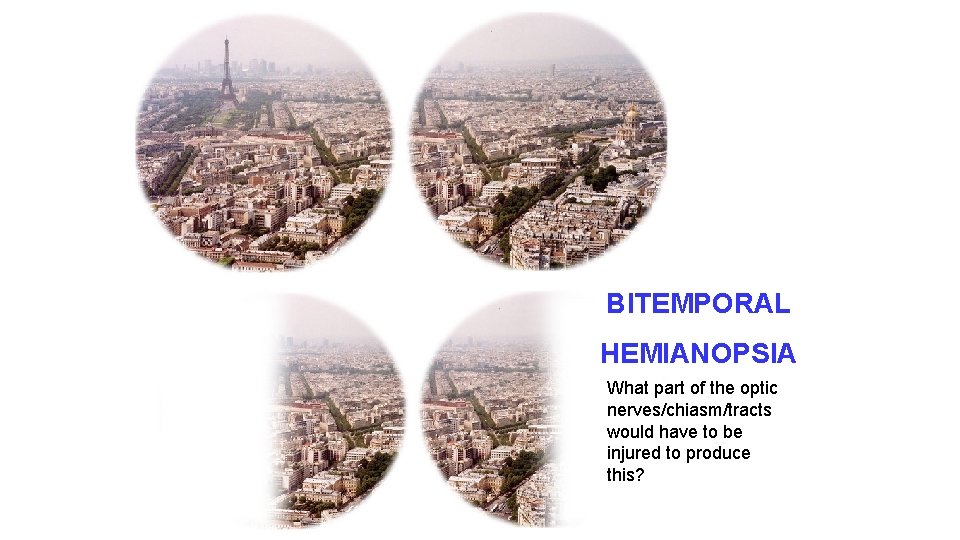 BITEMPORAL HEMIANOPSIA What part of the optic nerves/chiasm/tracts would have to be injured to