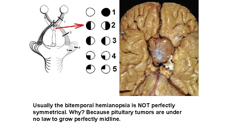 Usually the bitemporal hemianopsia is NOT perfectly symmetrical. Why? Because pituitary tumors are under