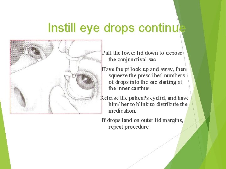Instill eye drops continue Pull the lower lid down to expose the conjunctival sac