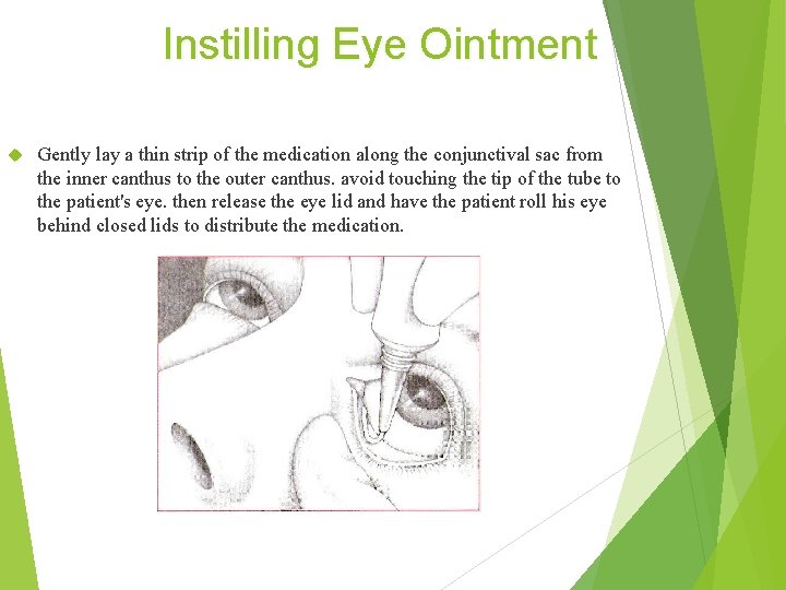 Instilling Eye Ointment Gently lay a thin strip of the medication along the conjunctival