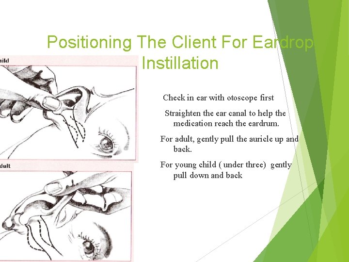 Positioning The Client For Eardrop Instillation Check in ear with otoscope first Straighten the