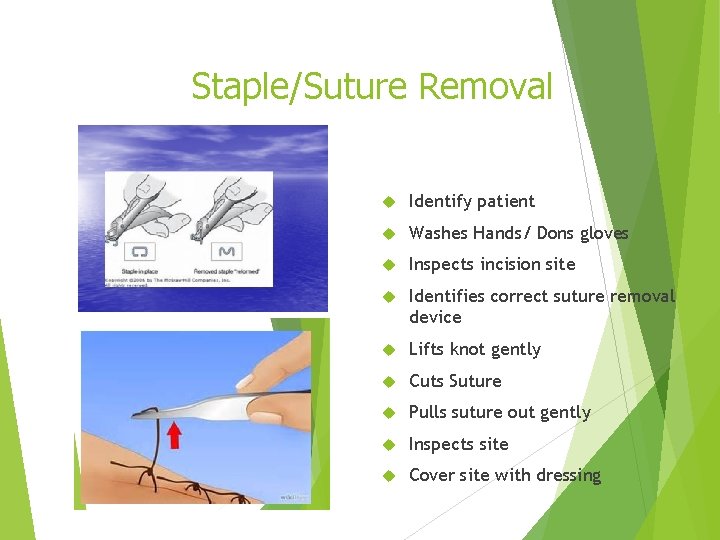 Staple/Suture Removal Identify patient Washes Hands/ Dons gloves Inspects incision site Identifies correct suture