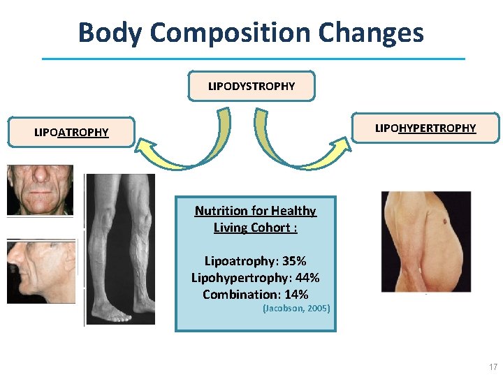 Body Composition Changes LIPODYSTROPHY LIPOHYPERTROPHY LIPOATROPHY Nutrition for Healthy Living Cohort : Lipoatrophy: 35%