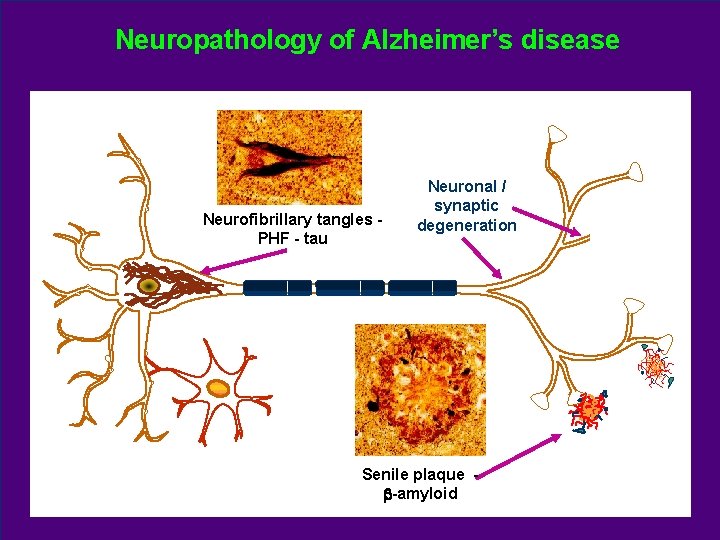 Neuropathology of Alzheimer’s disease Neurofibrillary tangles PHF - tau Neuronal / synaptic degeneration Senile