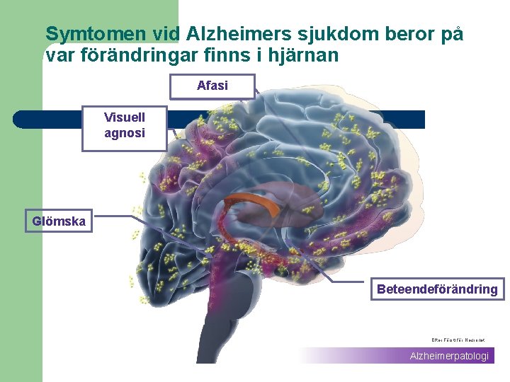 Symtomen vid Alzheimers sjukdom beror på var förändringar finns i hjärnan Afasi Aphasia Visuell