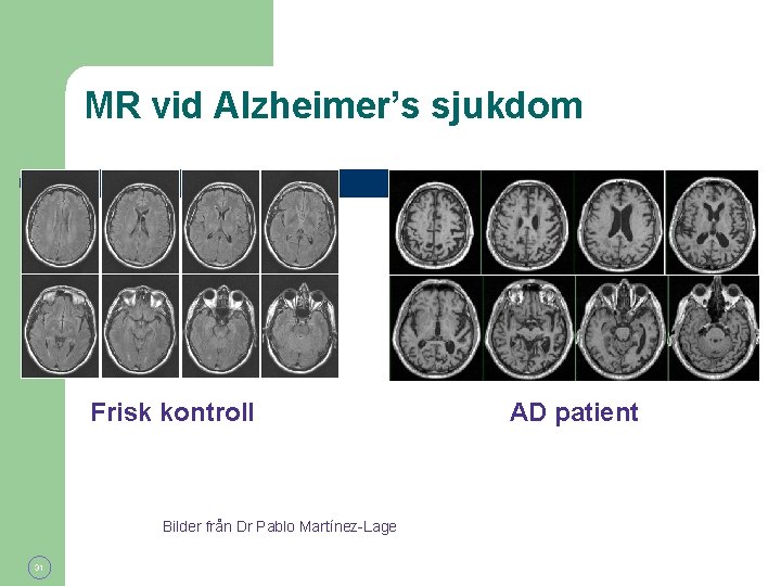 MR vid Alzheimer’s sjukdom Frisk kontroll Bilder från Dr Pablo Martínez-Lage 31 AD patient
