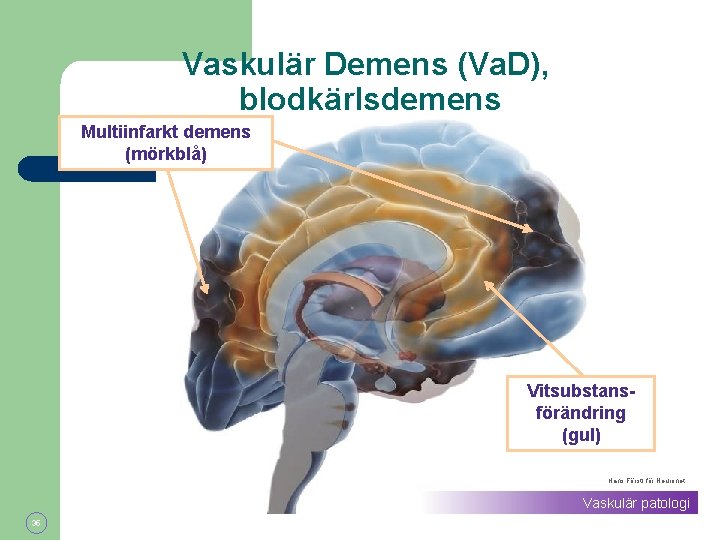 Vaskulär Demens (Va. D), blodkärlsdemens Multiinfarkt demens (mörkblå) Vitsubstansförändring (gul) Hans Förstl för Neuronet