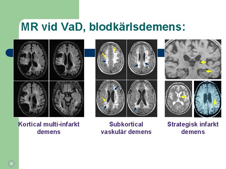 MR vid Va. D, blodkärlsdemens: Kortical multi-infarkt demens 36 Subkortical vaskulär demens Strategisk infarkt