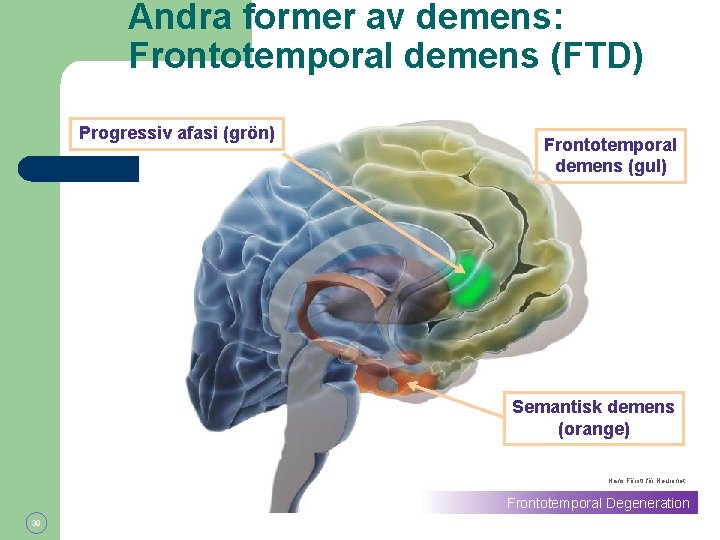 Andra former av demens: Frontotemporal demens (FTD) Progressiv afasi (grön) Frontotemporal demens (gul) Semantisk