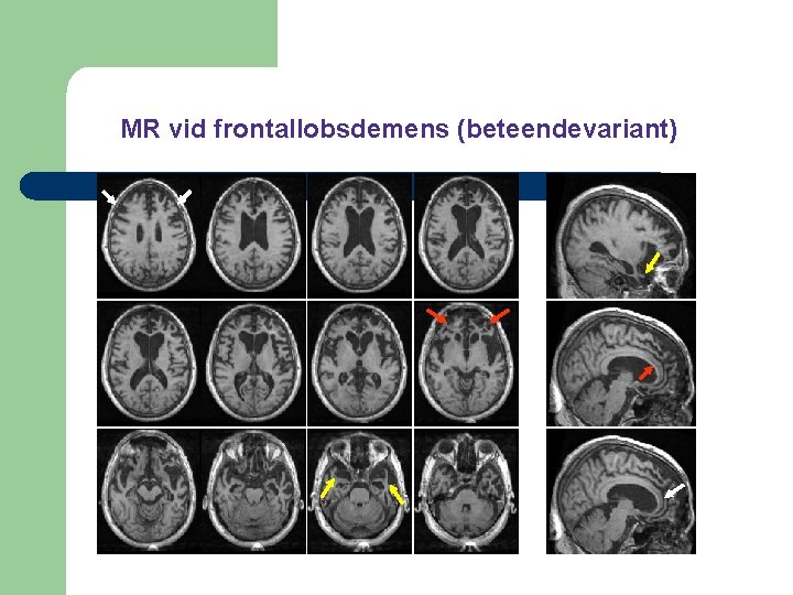 MR vid frontallobsdemens (beteendevariant) 
