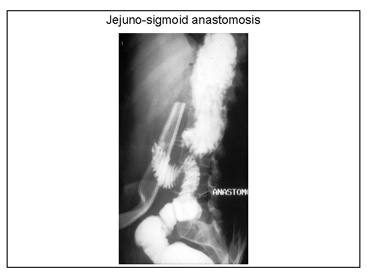 Jejuno-sigmoid anastomosis 