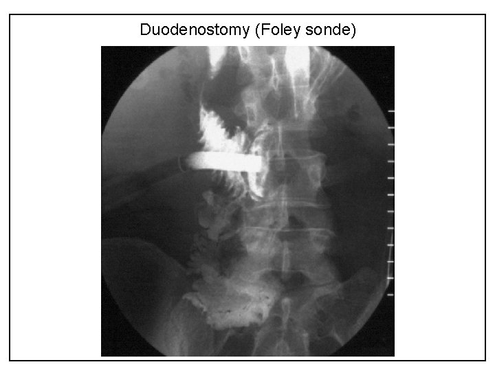 Duodenostomy (Foley sonde) 