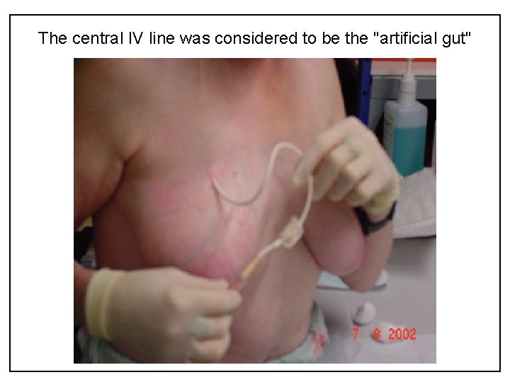The central IV line was considered to be the "artificial gut" 