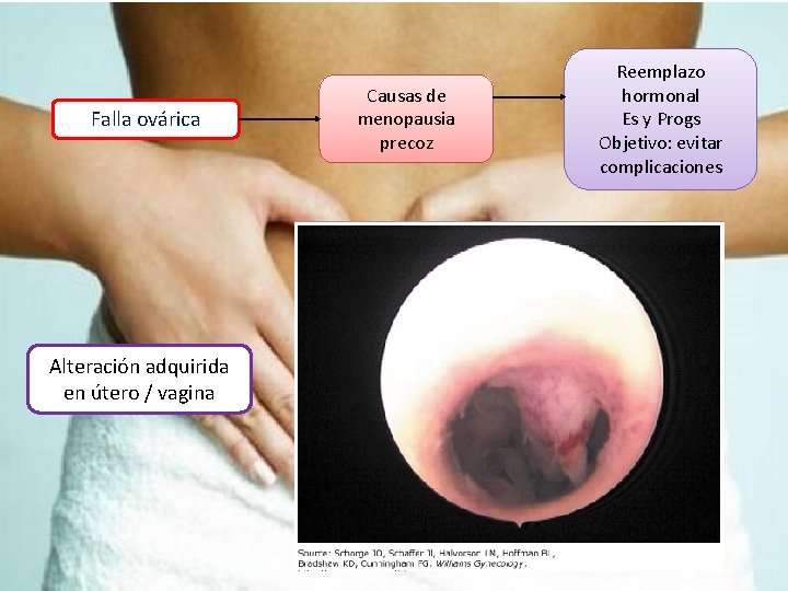 Falla ovárica Alteración adquirida en útero / vagina Causas de menopausia precoz Reemplazo hormonal