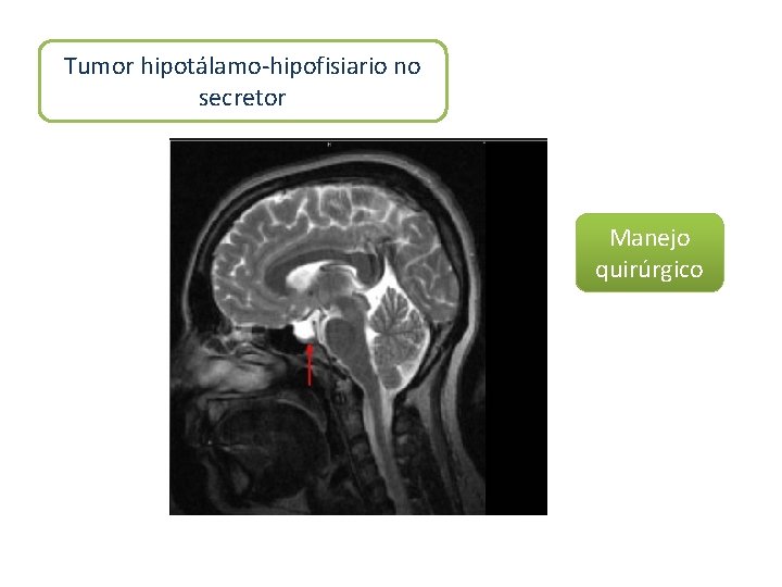Tumor hipotálamo-hipofisiario no secretor Manejo quirúrgico 