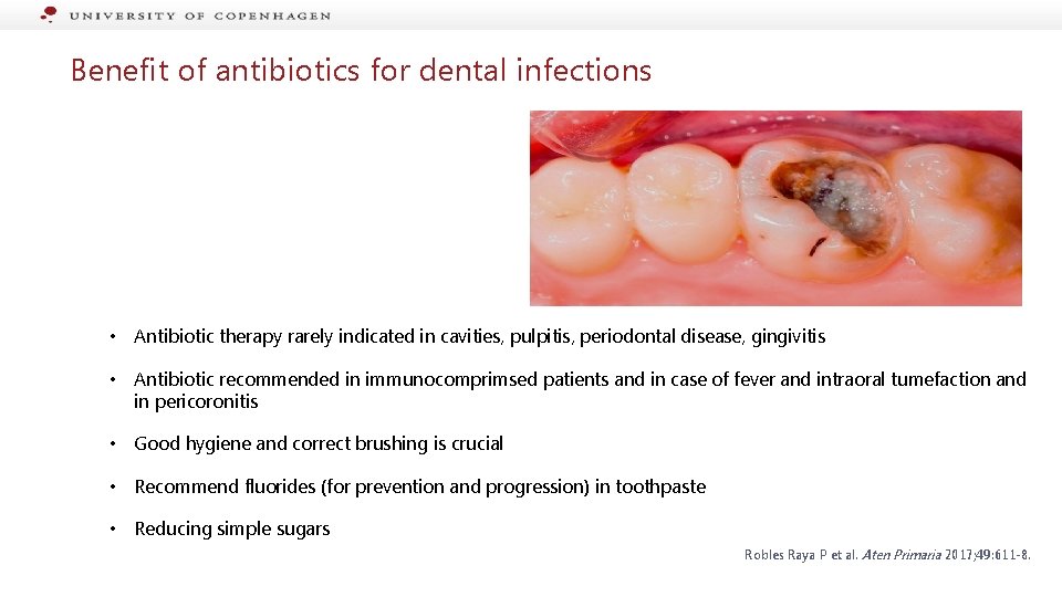Benefit of antibiotics for dental infections • Antibiotic therapy rarely indicated in cavities, pulpitis,