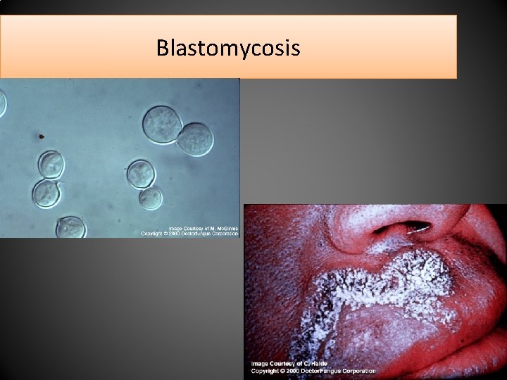 Blastomycosis 