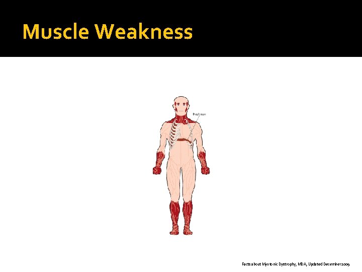 Muscle Weakness Facts about Myotonic Dystrophy, MDA, Updated December 2009 