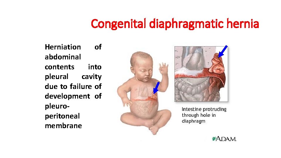 Congenital diaphragmatic hernia Herniation of abdominal contents into pleural cavity due to failure of