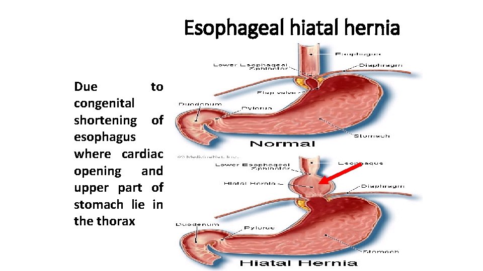 Esophageal hiatal hernia Due to congenital shortening of esophagus where cardiac opening and upper