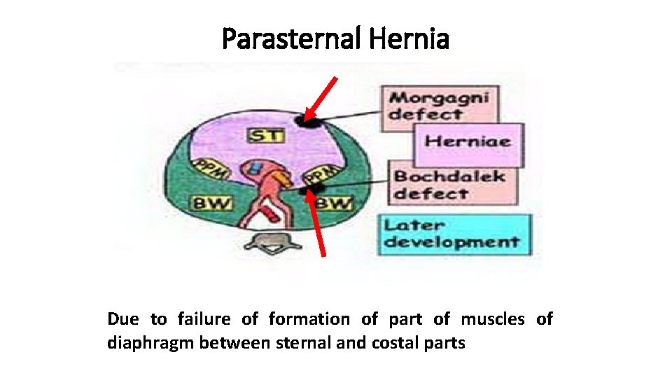 Parasternal Hernia Due to failure of formation of part of muscles of diaphragm between