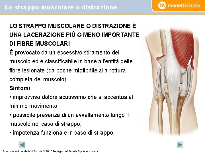 Lo strappo muscolare o distrazione LO STRAPPO MUSCOLARE O DISTRAZIONE È UNA LACERAZIONE PIÙ