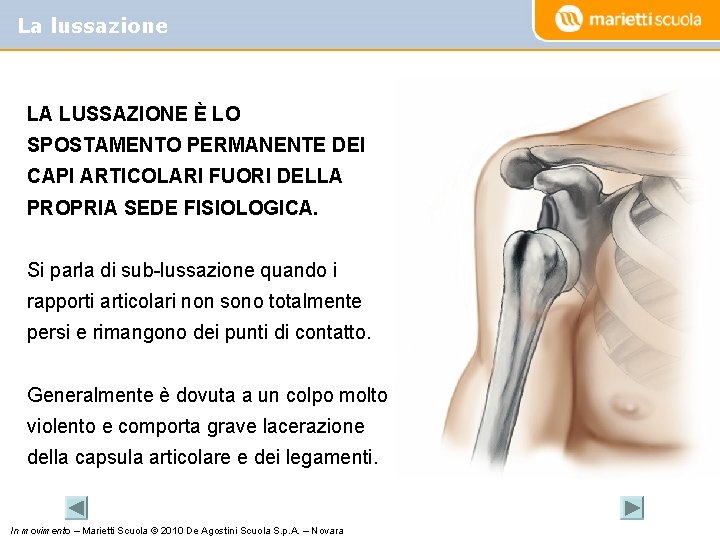 La lussazione LA LUSSAZIONE È LO SPOSTAMENTO PERMANENTE DEI CAPI ARTICOLARI FUORI DELLA PROPRIA