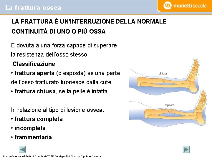 La frattura ossea LA FRATTURA È UN'INTERRUZIONE DELLA NORMALE CONTINUITÀ DI UNO O PIÙ