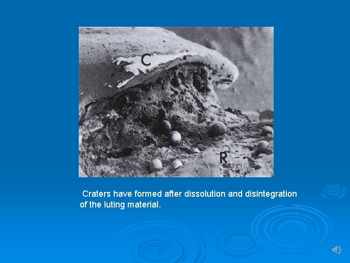 Craters have formed after dissolution and disintegration of the luting material. 