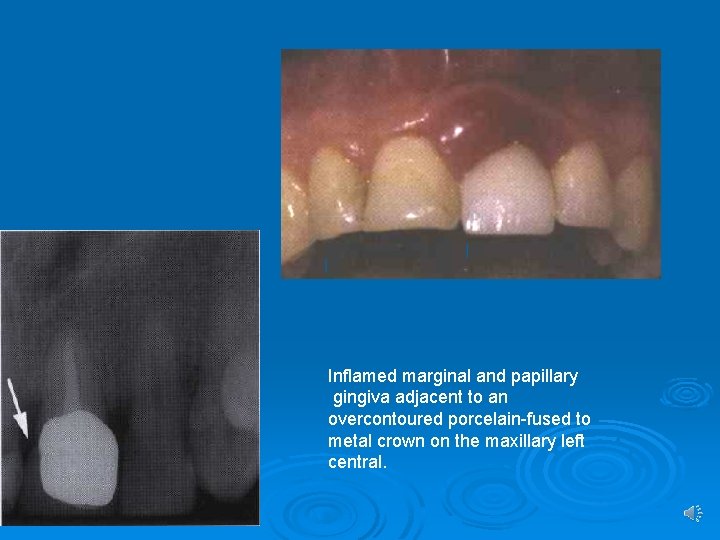 Inflamed marginal and papillary gingiva adjacent to an overcontoured porcelain-fused to metal crown on