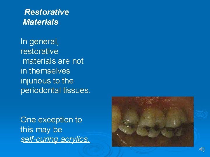 Restorative Materials In general, restorative materials are not in themselves injurious to the periodontal