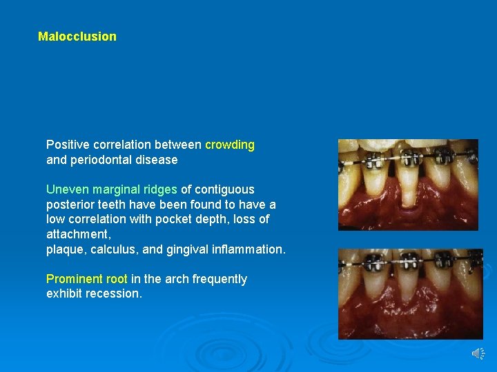 Malocclusion Positive correlation between crowding and periodontal disease Uneven marginal ridges of contiguous posterior